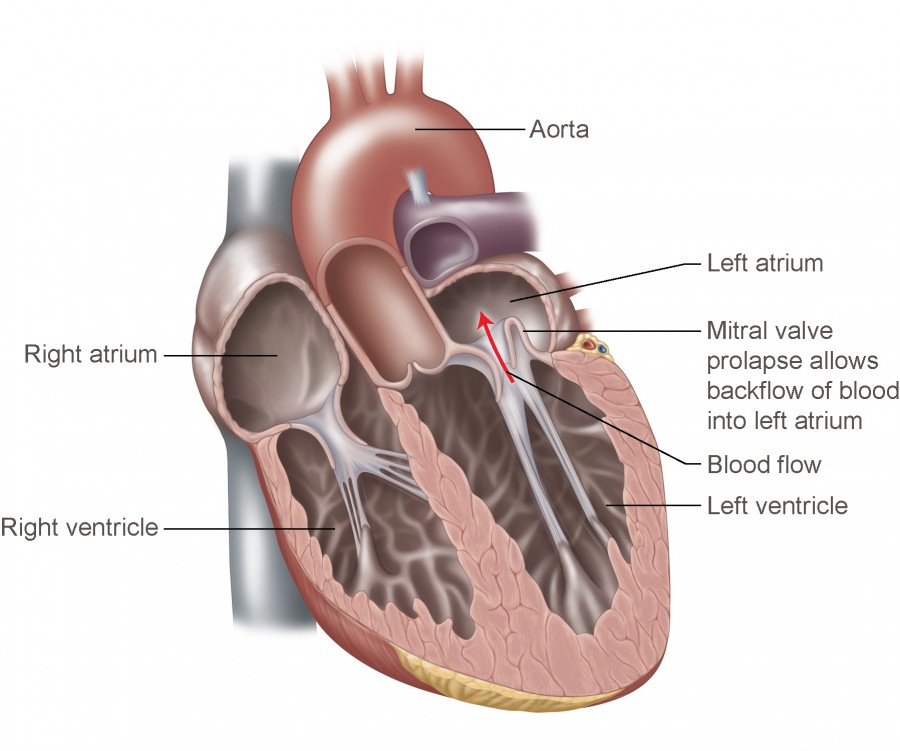 Mitral Valve Prolapse Temple Health